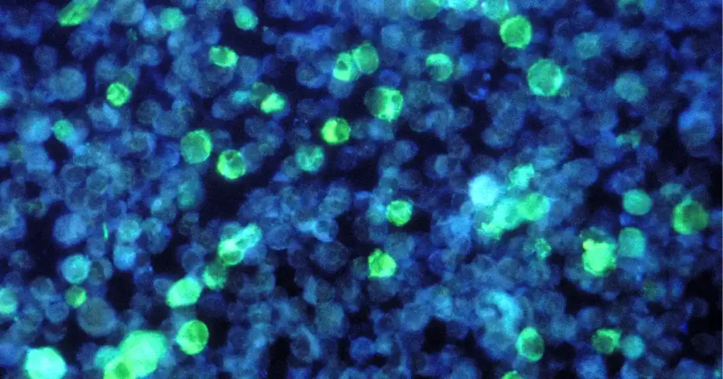 What Is the Life Expectancy of Someone with Epstein-Barr Virus?